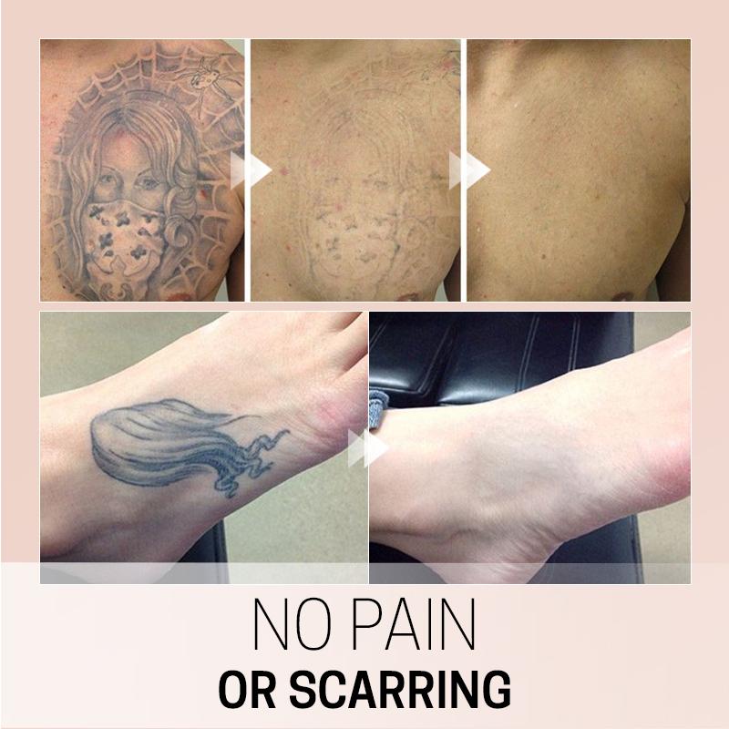TatEraser™ Tattoo Removal Cream