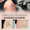 TatEraser™ Tattoo Removal Cream